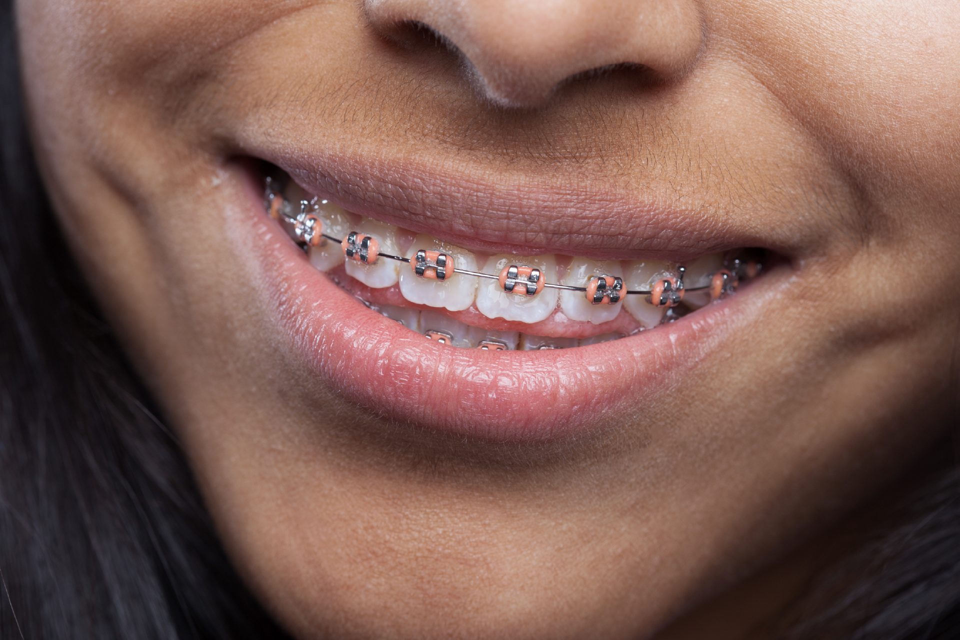 ortodoncia con brackets