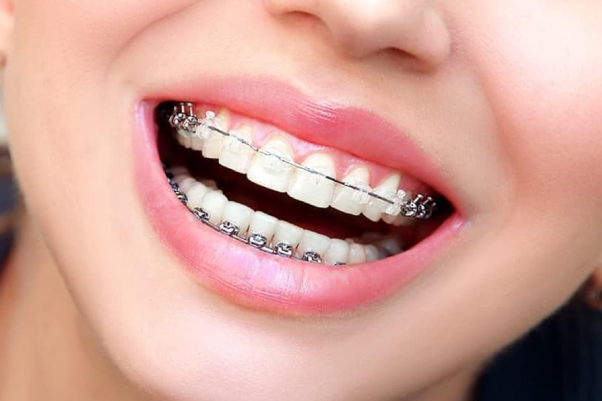 ortodoncia brackets esteticos