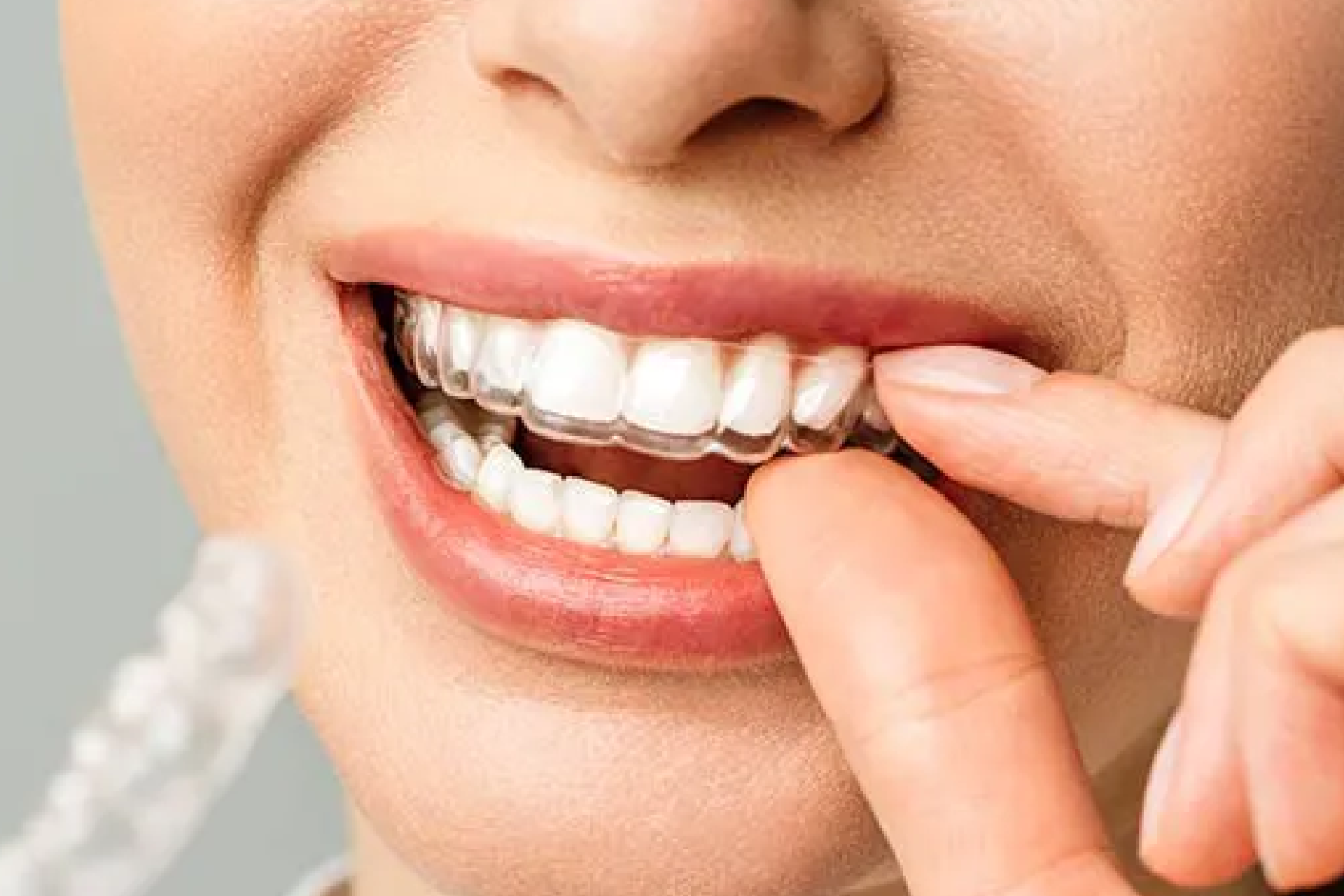 ortodoncia con alineadores invisibles