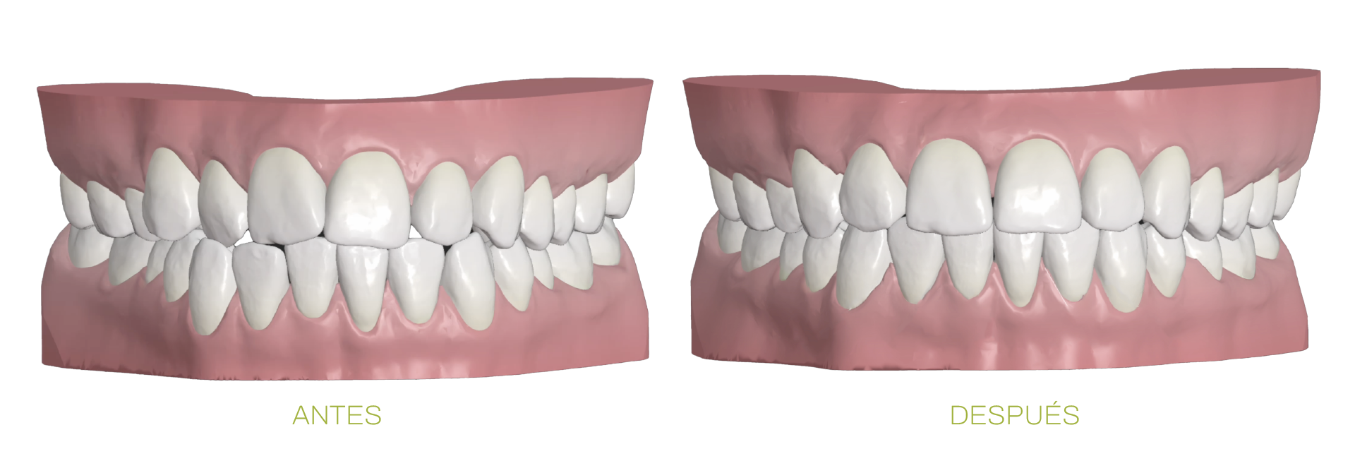 ORTODONCIA ANTES Y DESPUES