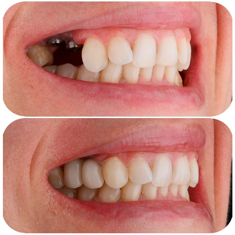 implante antes y despues