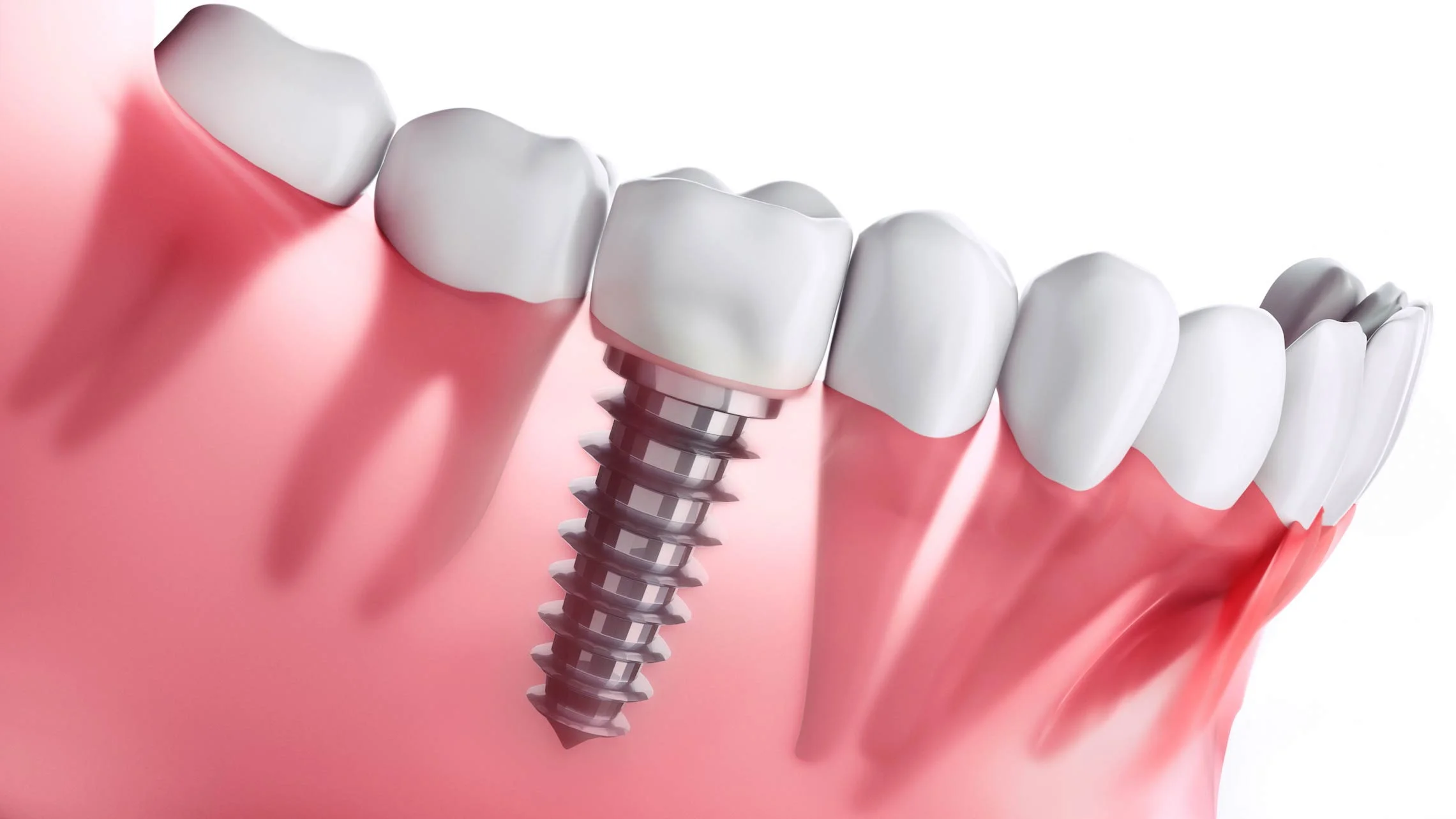implantes dentales popayan